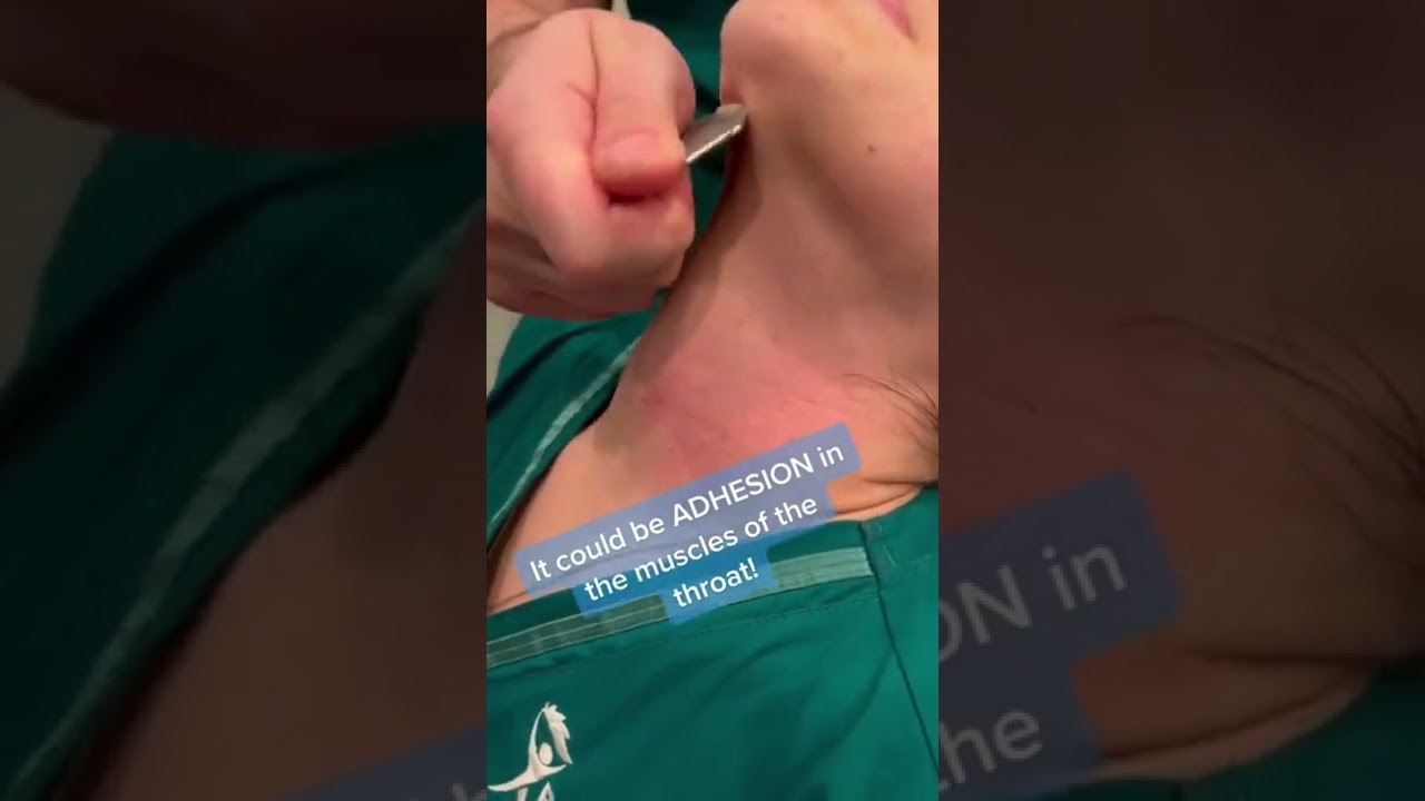 Adhesion Treatment for Tight Throat When It’s Been Over 6 Months