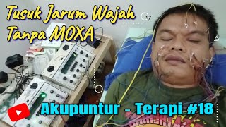 Terapi Akupuntur Bell's Palsy | Fisioterapi syaraf wajah  #18