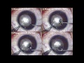 Surgical technique for opening the small incision and pocketing the cap and lenticule interfaces