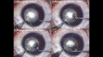 Surgical technique for opening the small incision and pocketing the cap and lenticule interfaces