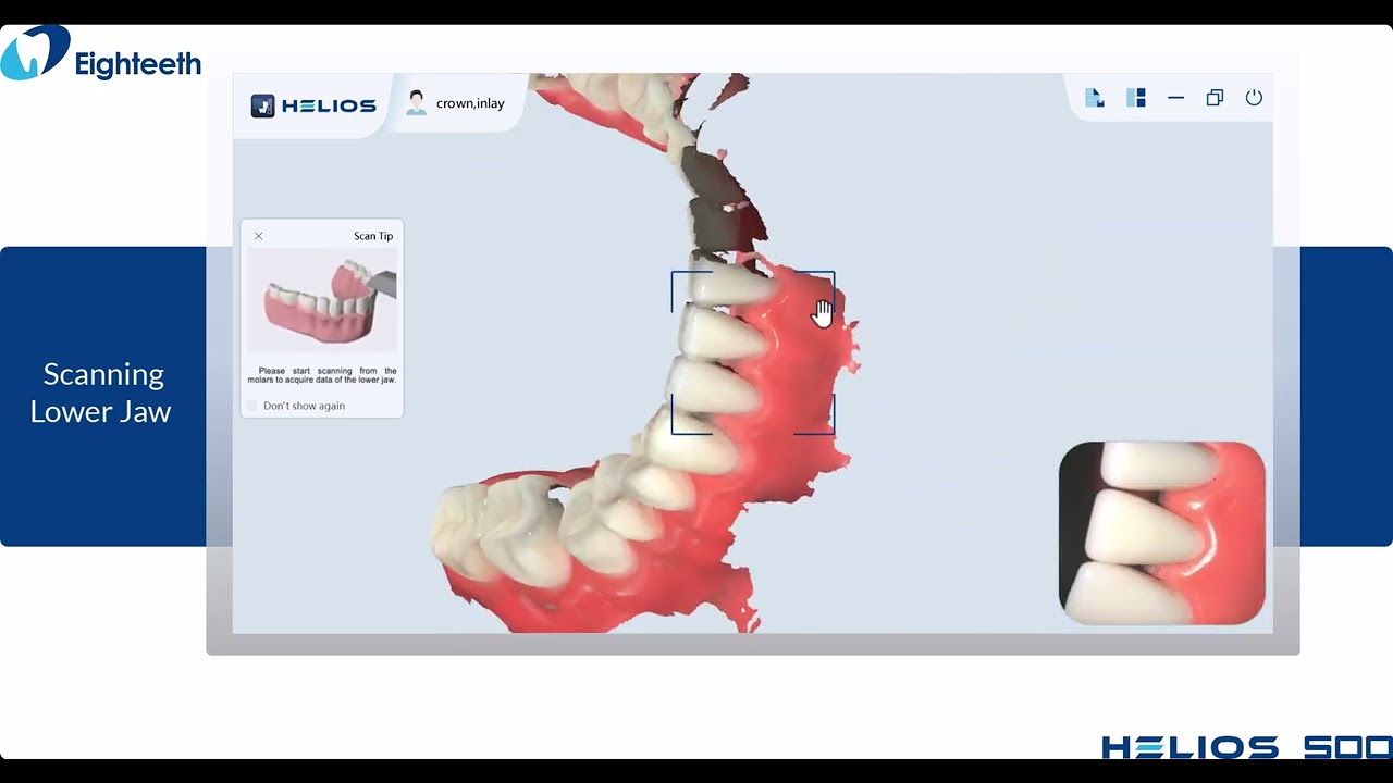 2 Helios 500 Inlay&Crown Workflow