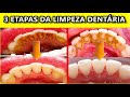 Limpeza Dentária: Como Funciona e quais etapas (resumo).