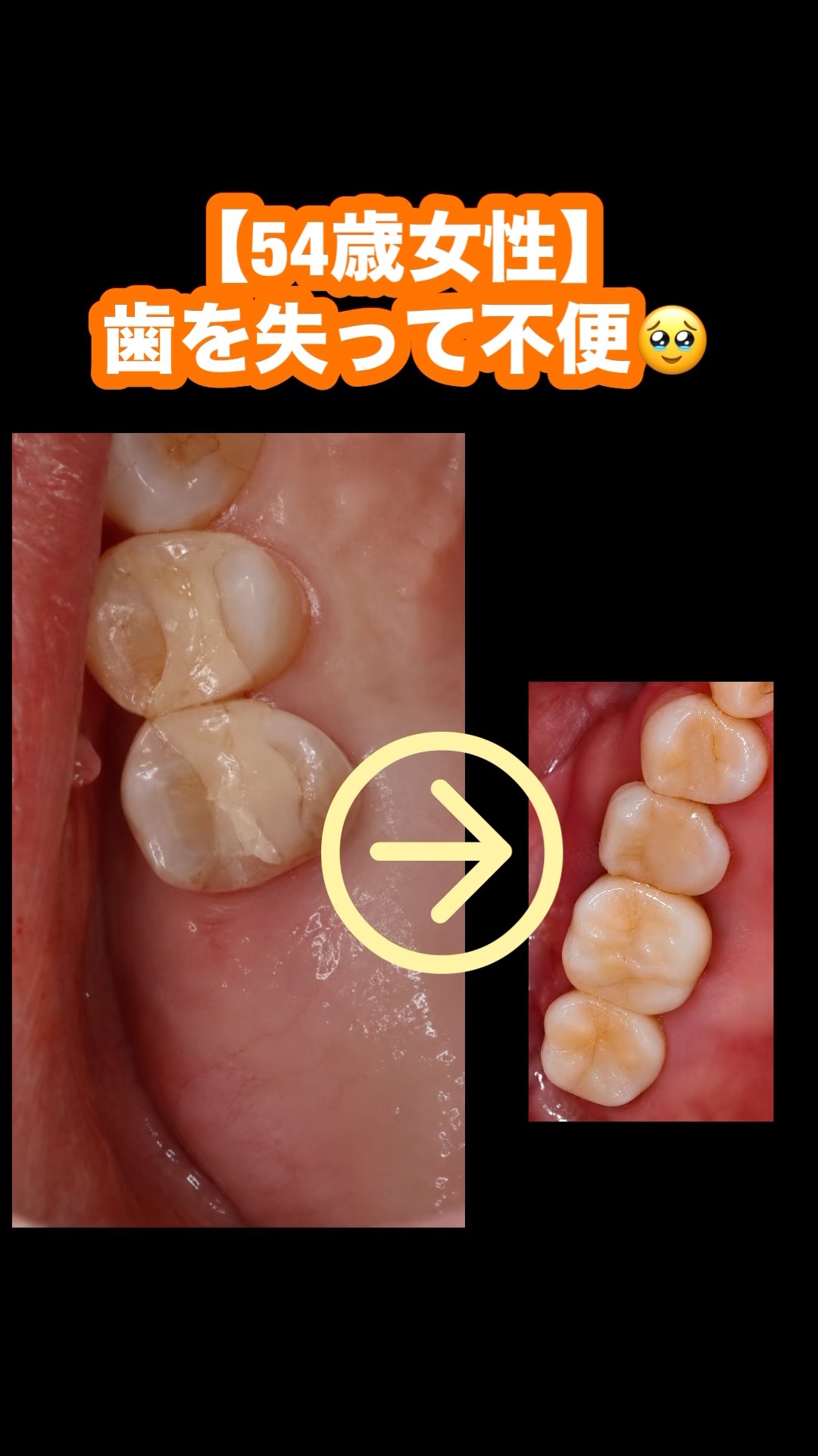 Case study of a 54-year-old woman who lost two upper right teeth