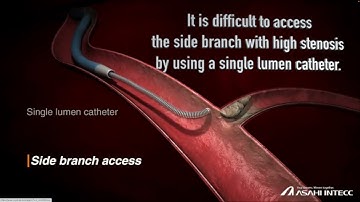 Angioplasty technique: Wiring into the side branch with high stenosis.