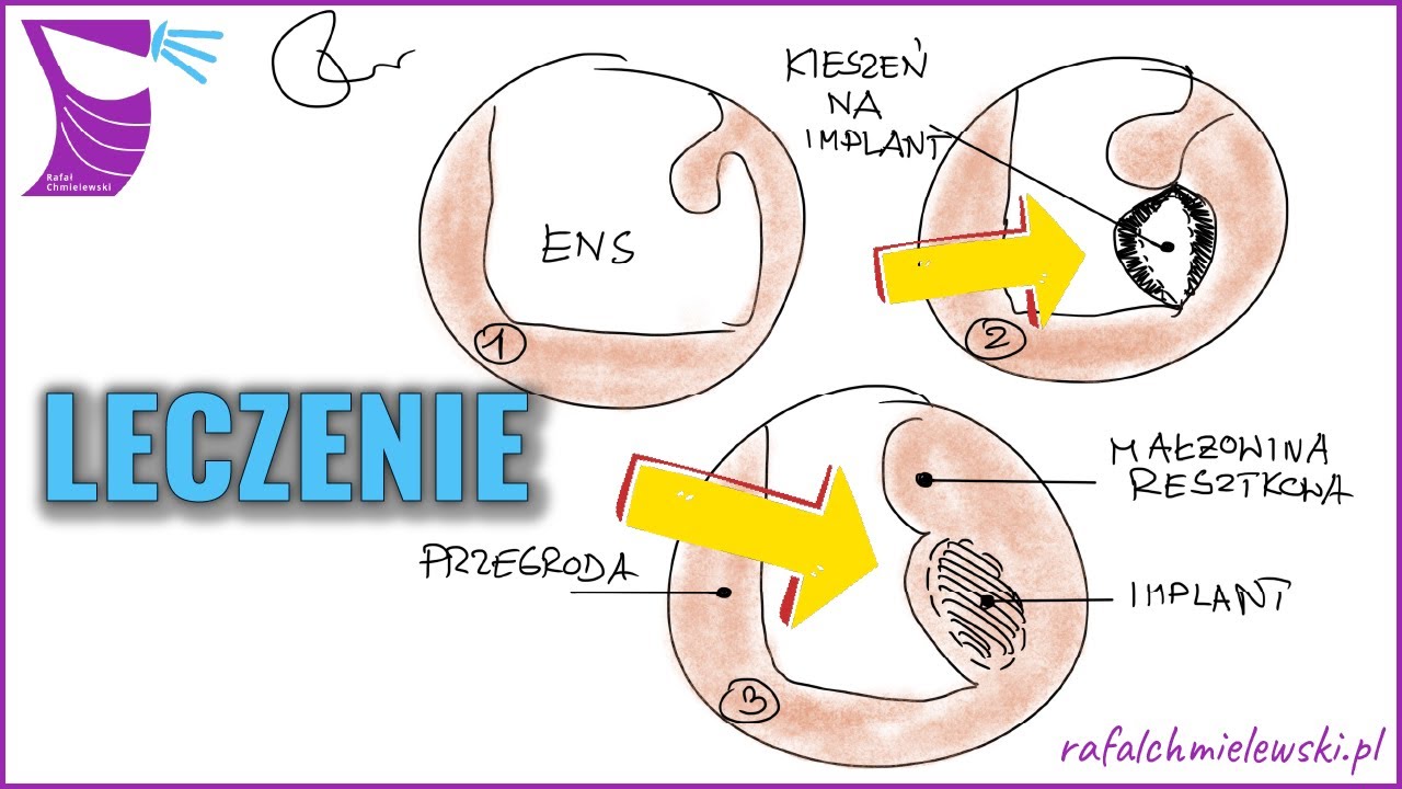 Leczenie Zespołu Pustego Nosa — Postępowanie Zachowawcze i Zabiegowe