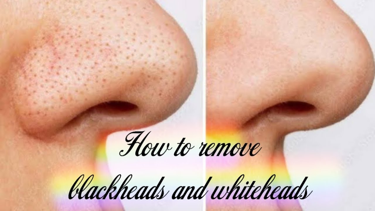 Blackheads and whiteheads removal Umme YouTube
