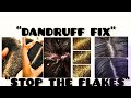 “Why You Keep Getting Dandruff (And How to Fix It Properly)” beauty and lifestyle.