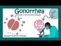 Gonorrhea: Signs & Symptoms | Neisseria gonorrhoeae | Diagnosis and Treatment of Gonorrhea | USMLE