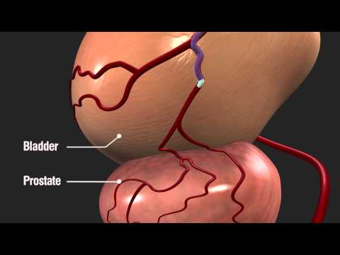 Prostatic Artery Embolization (PAE) with Magellan Robotic System