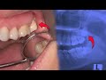 Removal of upper wisdom tooth that was embedded and not visible at all.