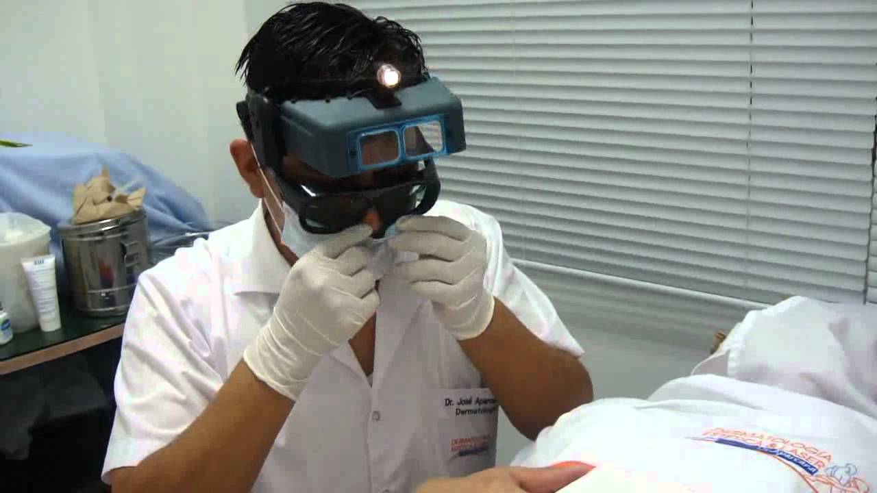 botox meaning Verrugas en las manos, tratamiento láser realizado por Dermatologos en Lima Perú