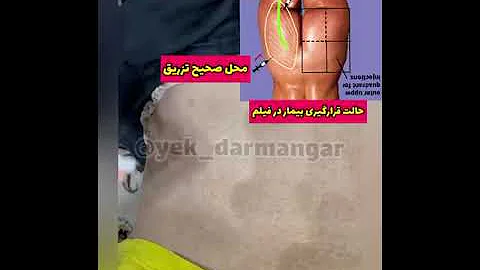 آموزش تزریق عضلانی Im Yek Darmangar تزریق تزریقات تزریق عضلانی آموزش 