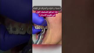 Tooth extraction for Braces قلع الضاحك الأول ? في تقويم الاسنان ؟؟ #yearofyou