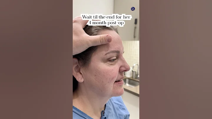 Natural Results| Face and Neck Lift 4 Months Post-Op| Before and After