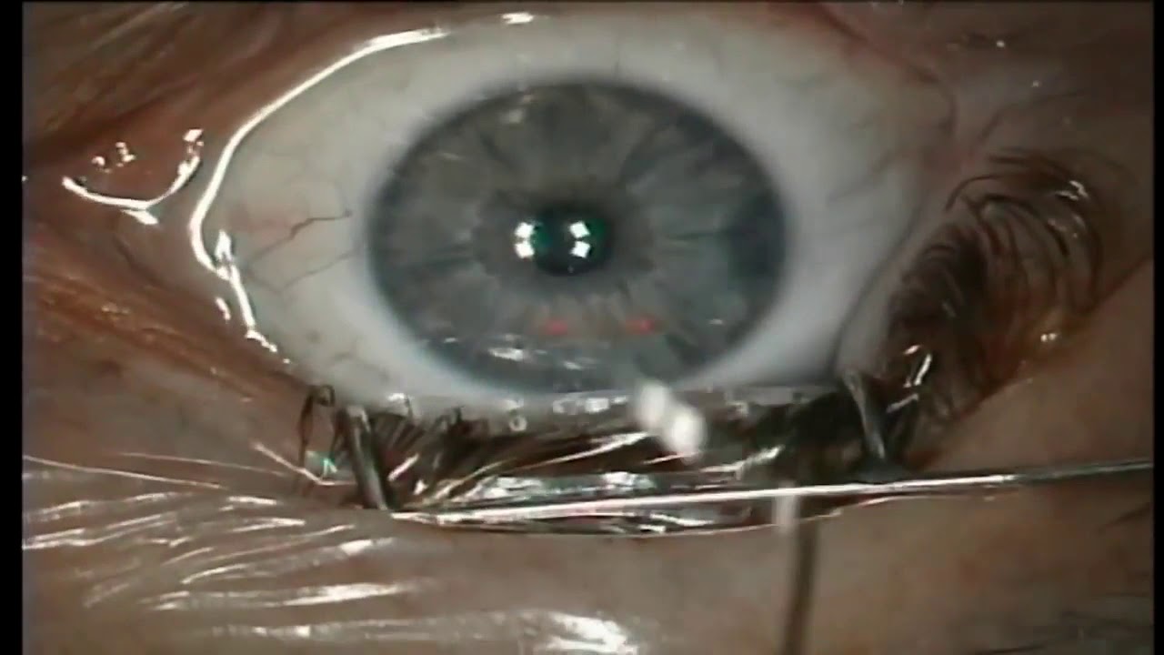 ФРК Лазерная Коррекция Зрения - YouTube