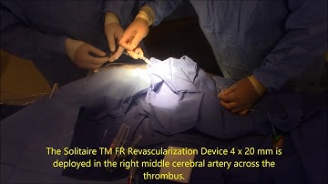 Mechanical thrombectomy for acute ischemic stroke.