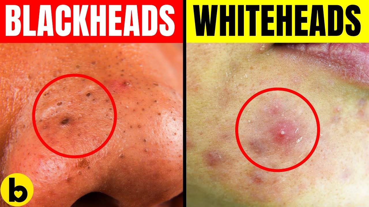 Blackheads Vs. Whiteheads What’s The Difference & How To Get Rid Of
