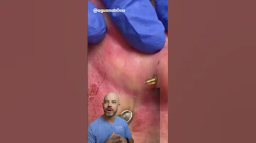 This Is An Iconic Ear Cyst Extraction Credit Aguanab0ca On TT Doctor Satisfying Viral 
