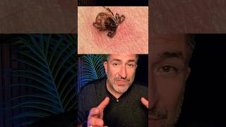 Are you in a #highrisk area for #lymedisease ? Watch out for #Ticks Follow for more #medicaltips