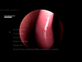 Haptic VR Endoscopic Sinus Examination Simulation - Nasendoscopy Sim