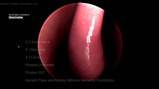 Haptic VR Endoscopic Sinus Examination Simulation - Nasendoscopy Sim