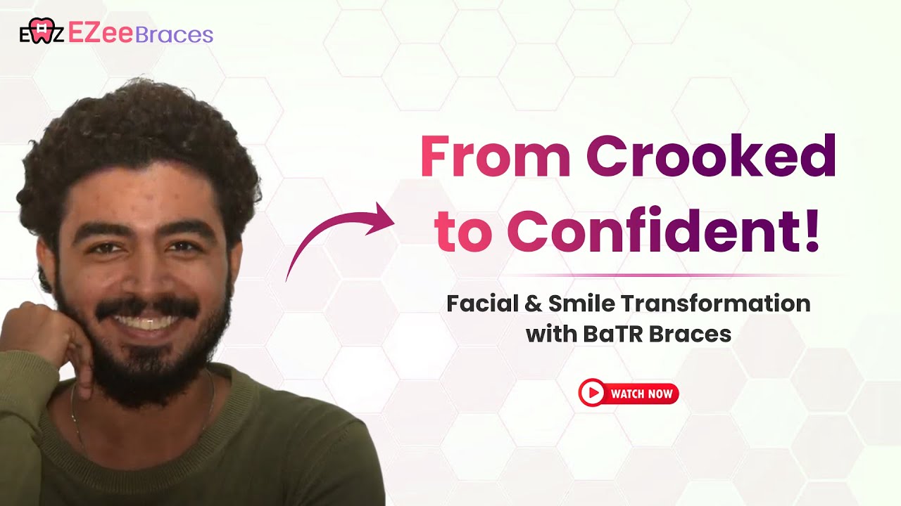 From Crooked Teeth to Confident Smile: How BaTR Braces Transformed This Face
