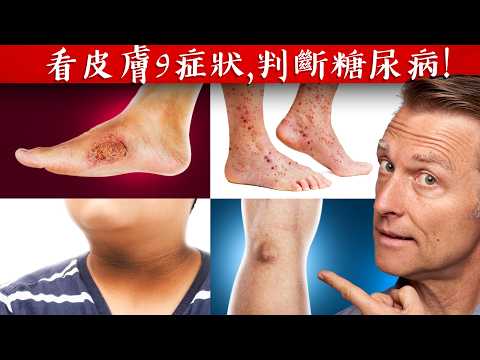 【皮膚】皮膚9症狀, 判斷糖尿病,降血糖自然療法,柏格醫生 Dr Berg