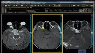 Neuro Imaging: Board and Recredentialing Review 10