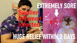 Not All Wisdom Tooth Surgery Is Bad (Partially Erupted Lower Third Molar Removal) by Dr Paul's Dental World 66,978 views 3 years ago 4 minutes, 13 seconds