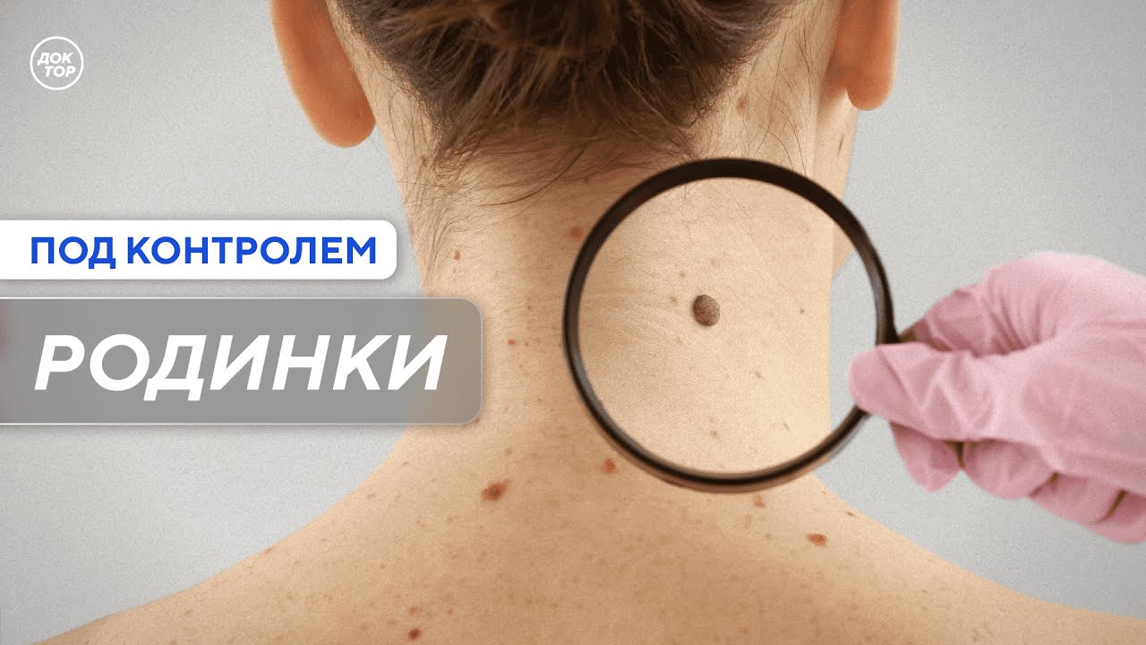 Сравнение родинок у родителей и детей