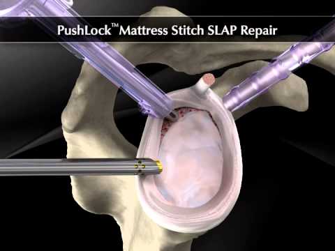 Arthrex   PushLock® Mattress Stitch SLAP Repair