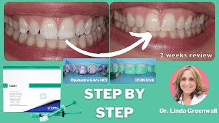 ICON Resin Infiltration for White Spots - Step by Step FULL PROTOCOL with Linda Greenwall PDP140