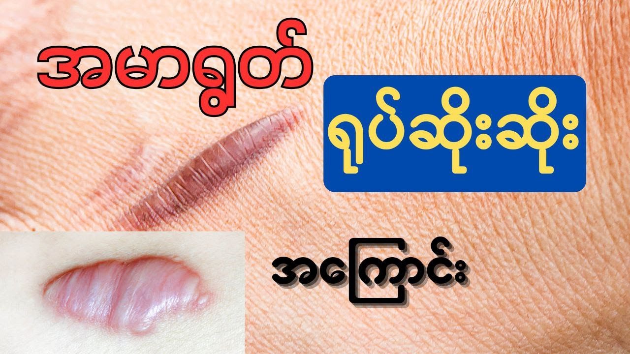အမာရွတ် ရုပ်ဆိုးဆိုး ‌အကြောင်း - keloid scar