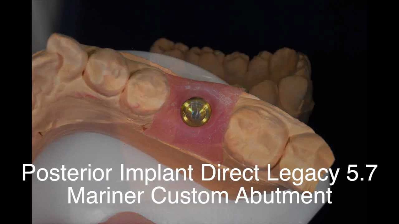 Implant Direct Customized Abutment and ScrewRetained Zirconia Crown