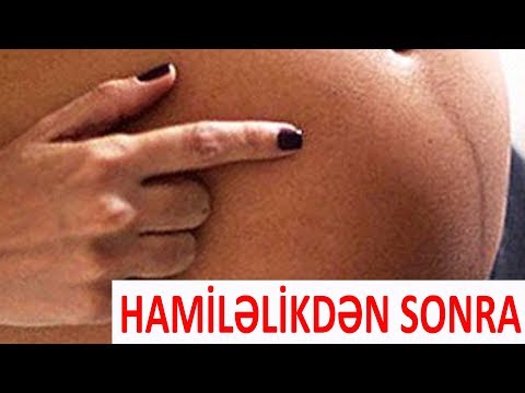 Hamiləlikdən sonra qarın sallanması - Necə qurtulmaq olar?