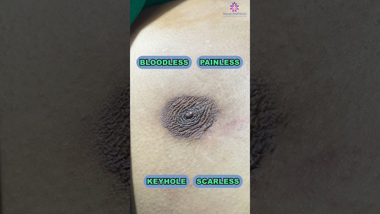 Another Successful Gynecomastia Surgery Results by Dr Arth Shah in Ahmedabad,Gujarat 