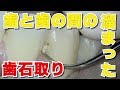 歯ブラシの届かないところには汚れがいっぱい溜まってる!!歯科検診 Remove Sticky Dental Tartar By Dental Check-up!!