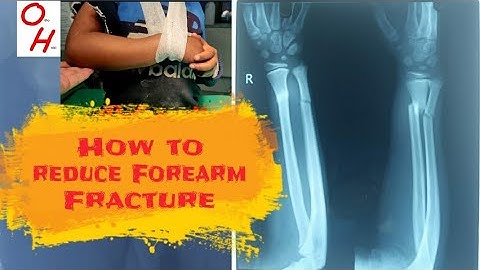 How to reduce a displaced fracture of Both Bones in a child