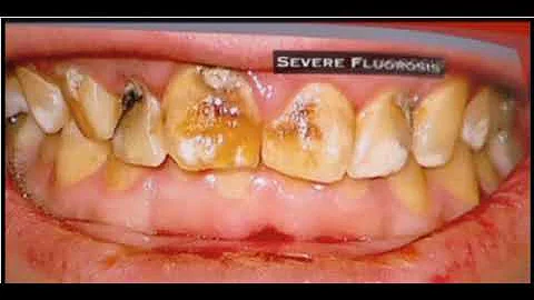 KENS5 - Joe Conger Fluoride Expose