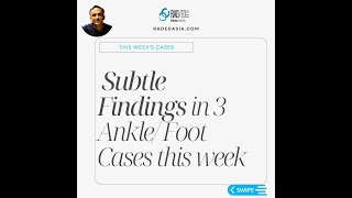 SUBTLE FINDINGS ANKLE & FOOT: 3 CASES FROM THIS WEEK