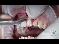 Gum Recession Treatment - Anterior Tooth