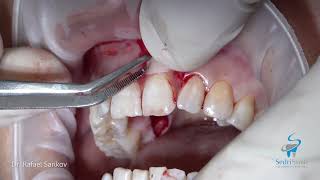 Gum Recession Treatment - Anterior Tooth