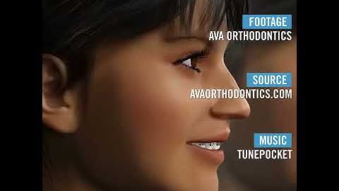 Full kiến thức về Niềng răng và mô hình khoa học