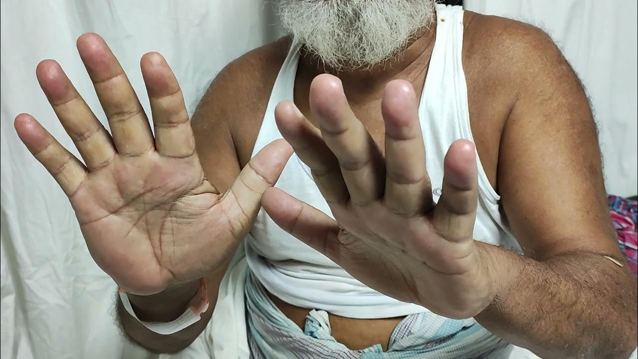 Flapping tremor a case of Hepatic encephalopathy YouTube