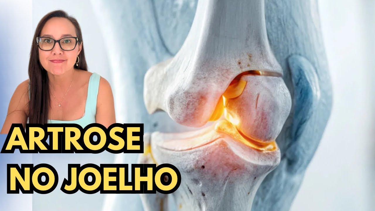 Artrose no Joelho: O que fazer para aliviar a dor no dia a dia