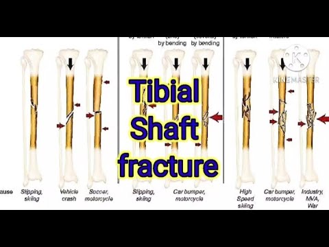 Tibial shaft fracture, bumper injuries systemic surgery Urdu/Hindi @TamknatPhysioRehab