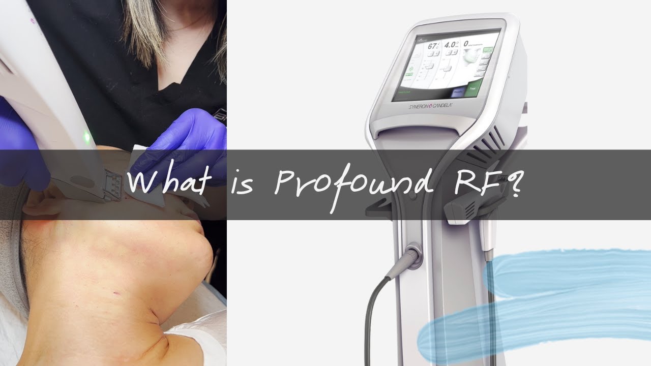 Profound RF Q&A with Registered Nurse (Everything you need to know)【BHPS】