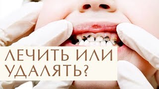 👧 Зачем лечить молочные зубы: рекомендации стоматолога. Зачем лечить молочные зубы. 12+