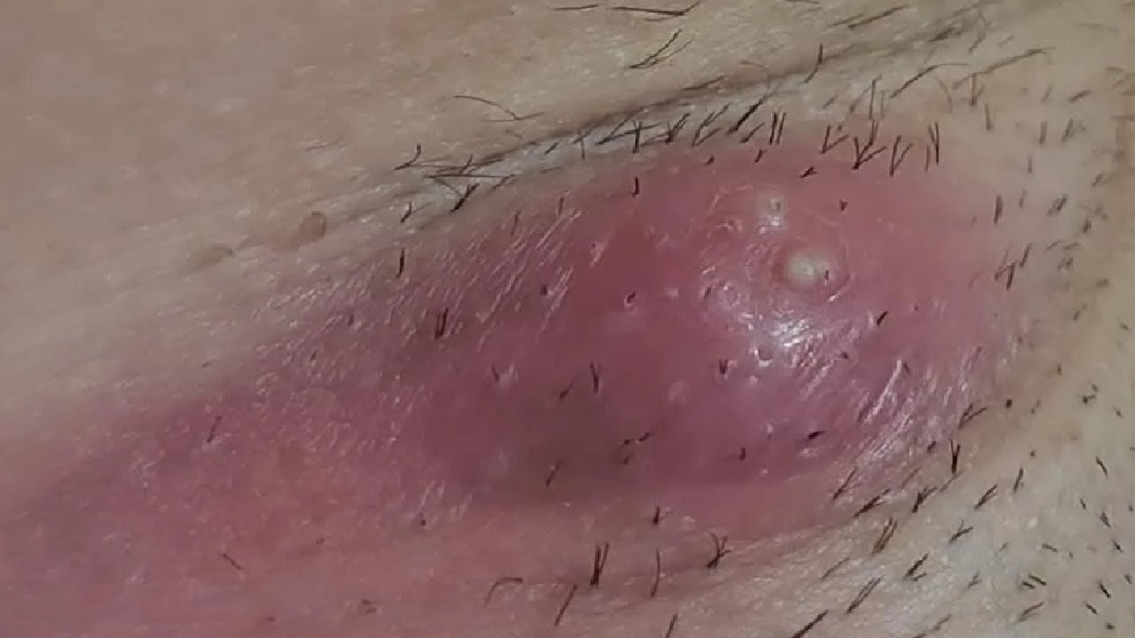 how to get rid of a boil under your arm works every time - YouTube