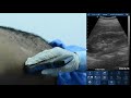 Renal ultrasound protocol with eagleview ultrasound scanner